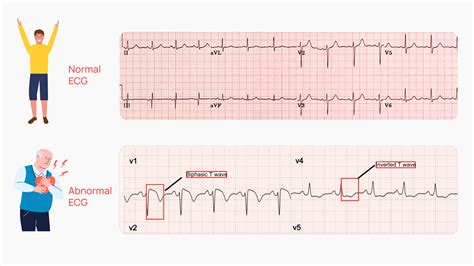Abnormal EKG: What It Means and Trea.
